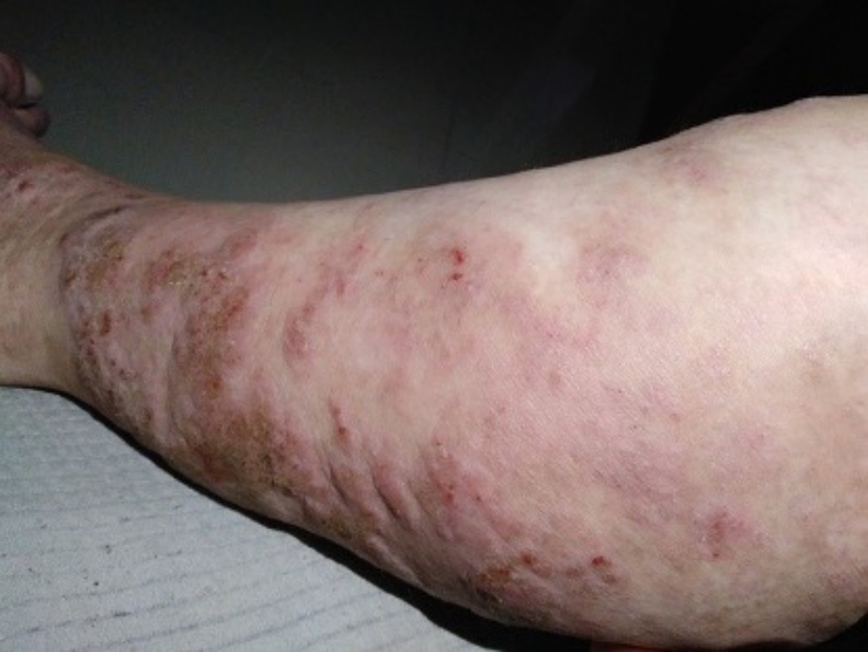 異位性皮膚炎病友協會提供