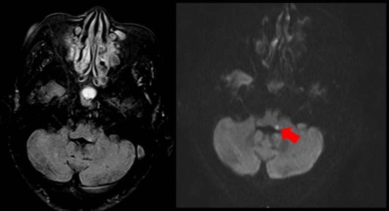 透過腦部核磁共振檢查,箭頭處亮點為血管梗塞位置,醫師診斷老婦人是腦幹梗塞型中風。恩主公醫院提供