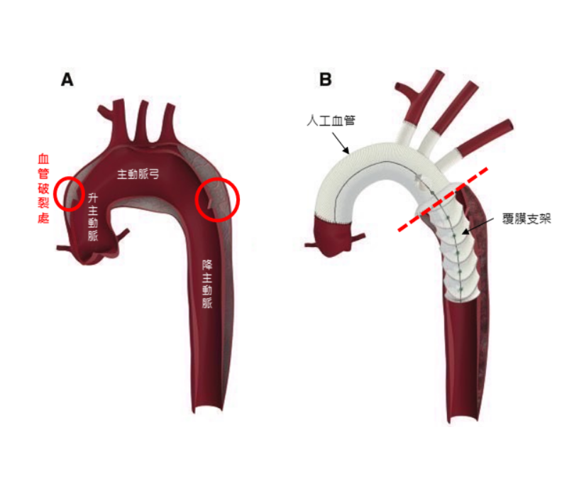 以往手術大多做主動脈弓置換,複合式主動脈人工血管多了一段覆膜支架,可以架到降主動脈(虛線下),一併將降主動脈問題解決,減少二次手術機會。恩主公醫院提供