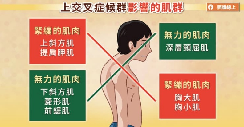 上交叉症候群影響的肌群。照護線上提供