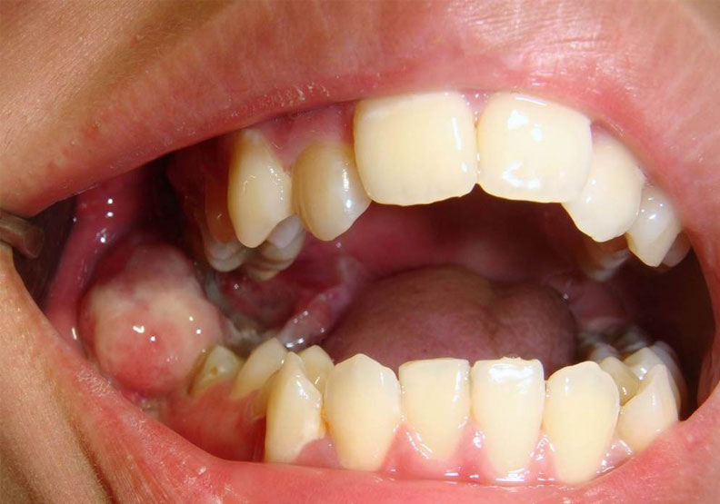 右下顎智齒拔除後乍看似傷口發炎,取樣化驗後診斷口腔癌第四期。台北慈濟醫院提供