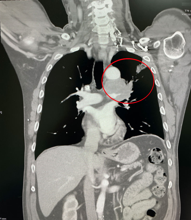 陳先生治療前胸部電腦斷層檢查,左上肺的腫瘤合併多處淋巴腺轉移。烏日林新醫院提供