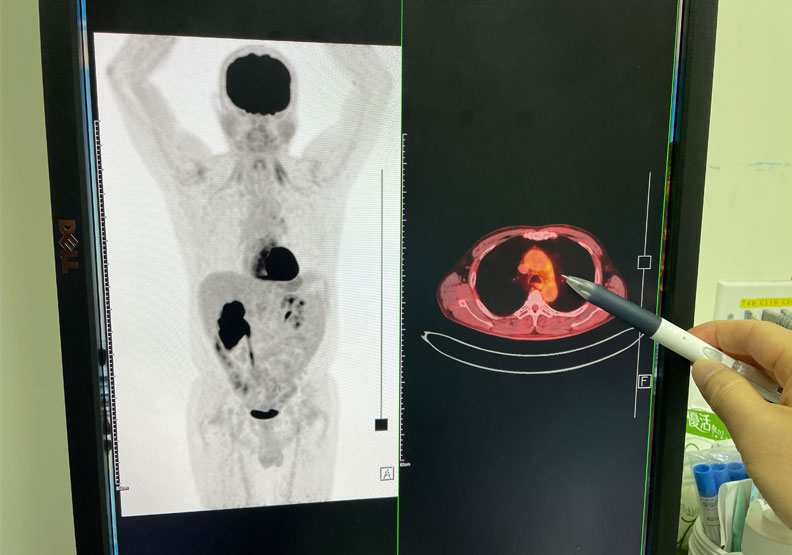陳先生接受治療小細胞肺癌一年半後安排正子電腦斷層掃描,成功把癌細胞全部殺死。烏日林新醫院提供