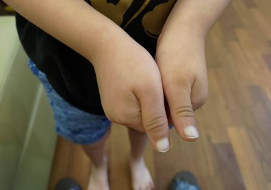 男童染疫後手腳指甲全變白！醫：病毒感染釀小血栓導致