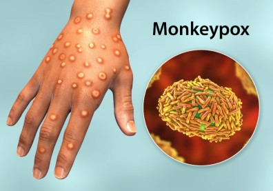 感染科醫師解析！猴痘起因、傳染途徑、症狀、預防與疫苗一次看懂