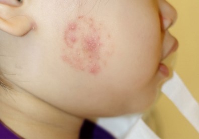 網購「止癢貼布」1歲半女娃皮膚過敏起紅疹！醫籲使用注意4件事