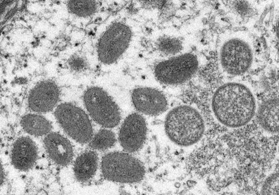 全球首例三病一體！義大利男出國5天染猴痘、新冠、愛滋3種病毒