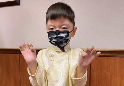 蒙古罕病童患亞伯氏症「玫瑰花蕾手」，來台手術治療翻轉人生