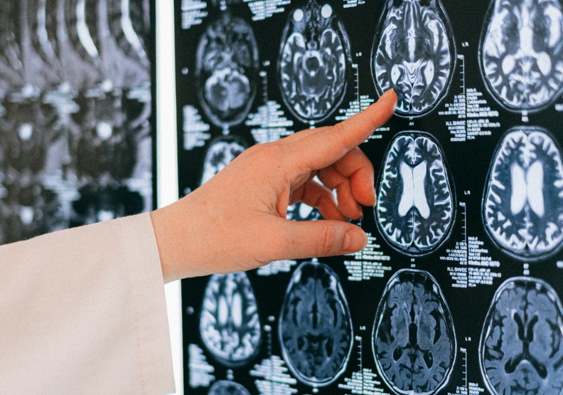 研究人員從3935名患者的大腦核磁共振影像（MRI）、遺傳分析和觀察數據中收集訊息，以分析高血壓對認知功能的影響。僅為情境配圖，取自Pexels