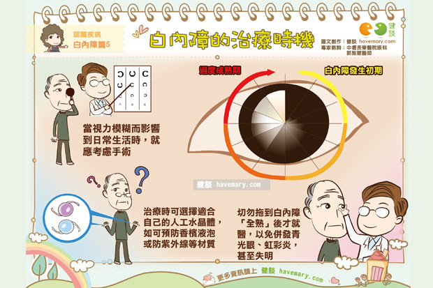 趁早還是全熟？白內障治療時機這樣抓