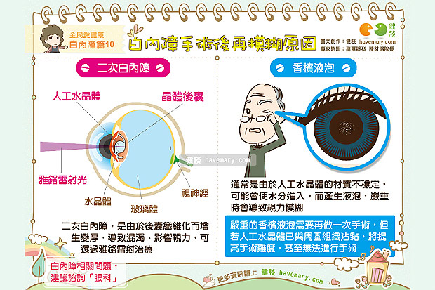 白內障術後視力再次模糊？兩大原因要注意！