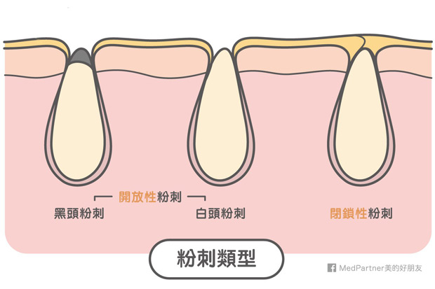 一次搞懂！毛孔粉刺成因與處置完全攻略（醫師彙整最新版）