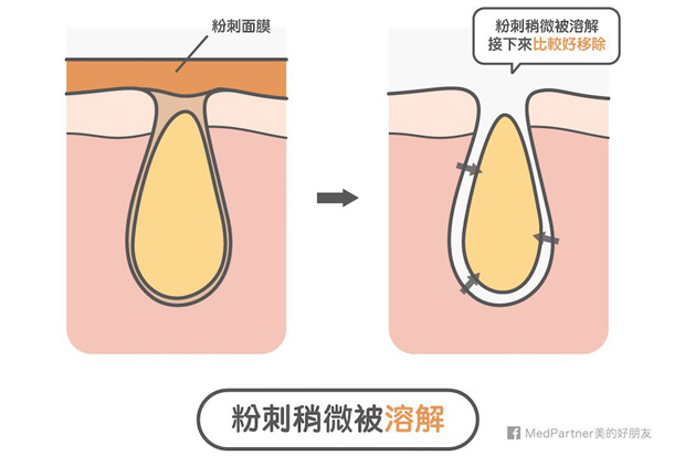 粉刺面膜可以用嗎？完整的原理是什麼？要注意哪些事項？
