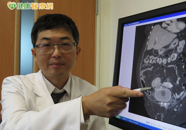 泌尿道反覆感染　恐是大腸膀胱瘻管作祟