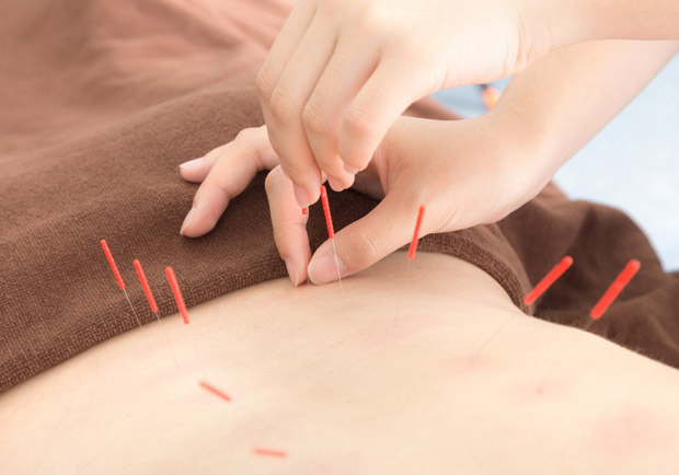 No pain No gain！英研究：針灸有助止痛、解鬱