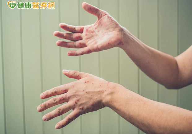 麻疹疫情連環爆！這兩種職業應特別當心