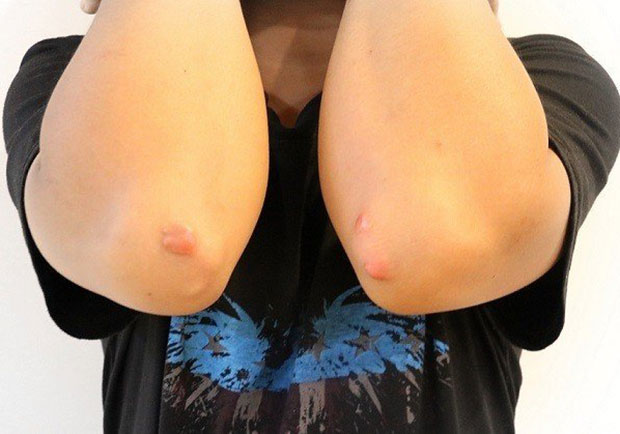 21歲海巡士兵手肘突冒小肉瘤，竟是心肌梗塞前兆