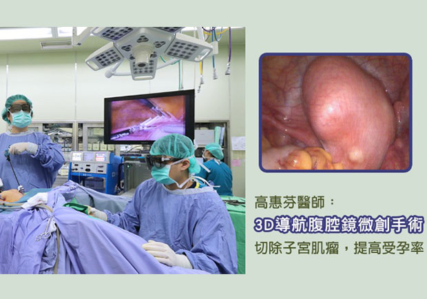 子宮肌瘤難受孕，3D腹腔鏡微創手術成「好孕」功臣