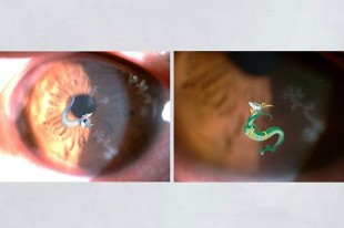 瘋抓寶貝致疱疹性角膜炎，驚見寶可夢上眼
