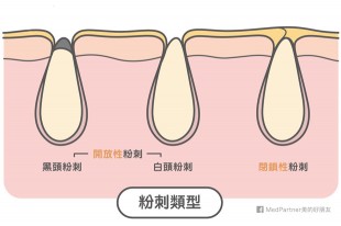 一次搞懂！毛孔粉刺成因與處置完全攻略（醫師彙整最新版）