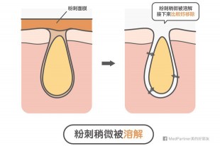 粉刺面膜可以用嗎？完整的原理是什麼？要注意哪些事項？
