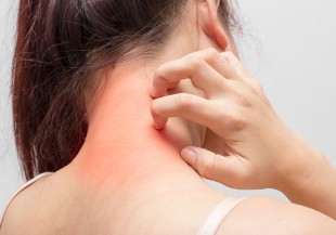 甜食導致體質痰濕 誘發蕁麻疹大爆發