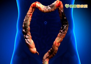 大腸癌部位分左右　會有不同症狀