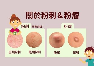熱敷，讓粉瘤和粉刺自爆