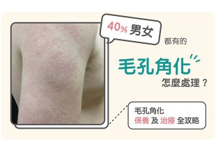 40% 男女都有的毛孔角化症怎麼處理？毛孔角化症保養及治療全攻略