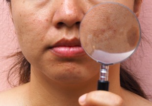 肝病不等於肝斑？原來是皮膚病