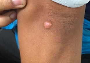 皮膚長出黃色瘤，小心血管被血脂塞滿