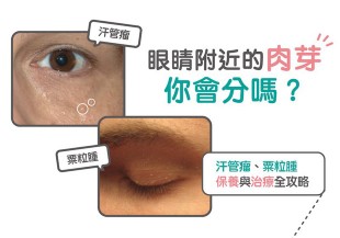 眼睛附近的肉芽你會分嗎？汗管瘤、粟粒腫的保養與治療全攻略