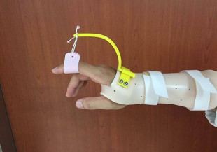 職能治療之副木製作與3D列印之應用