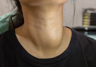 甲狀腺癌多好發於女性，出現這些症狀快就醫診斷