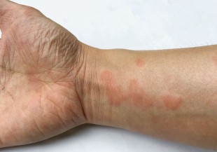 紅斑性狼瘡女性罹病率高，「自體免疫疾病」早期症狀難發現
