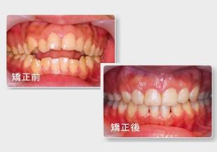 愛漂亮才需要矯正牙齒？咬合不正會帶來的 10 大影響