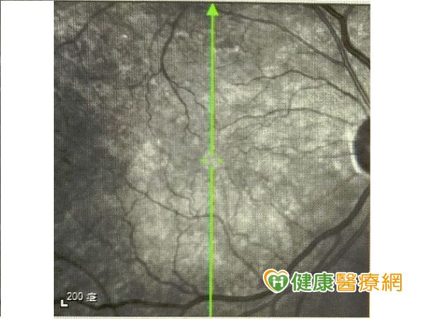 黃斑部皺摺致視力模糊,手術治療新曙光_img_3