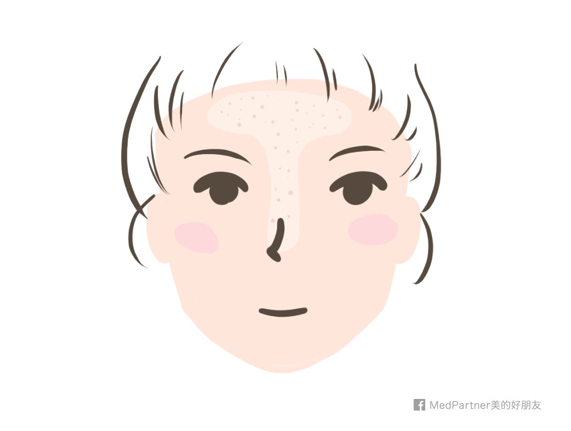 一次搞懂!毛孔粉刺成因與處置完全攻略(醫師彙整最新版)_img_1
