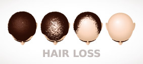 植髮後就不會再掉髮了嗎?植髮常見問與答_img_2