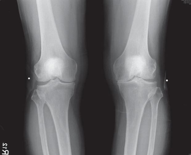 免置換人工膝關節,軟骨能自然修復的見證_img_1