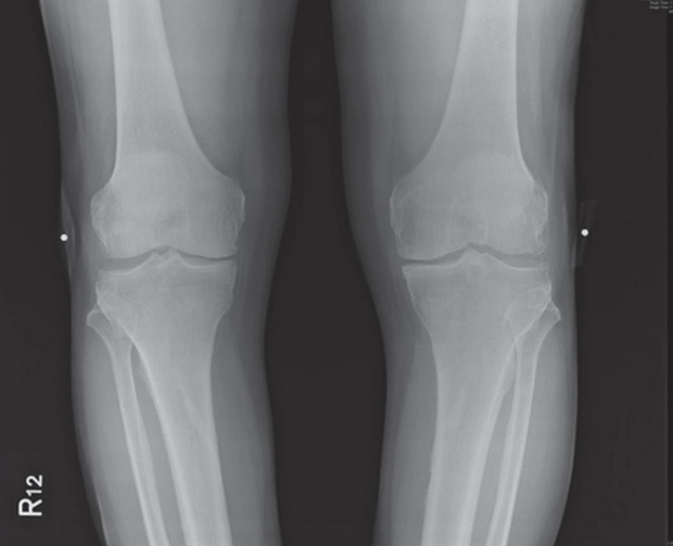 免置換人工膝關節,軟骨能自然修復的見證_img_2