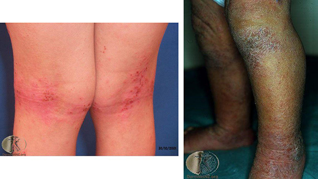 異位性皮膚炎根治與保養教學!醫師完整說明_img_4