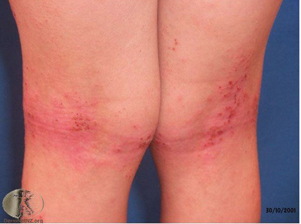 保濕常見疑惑:油水平衡跟外油內乾的真相是什麼?醫師完整揭秘_img_3