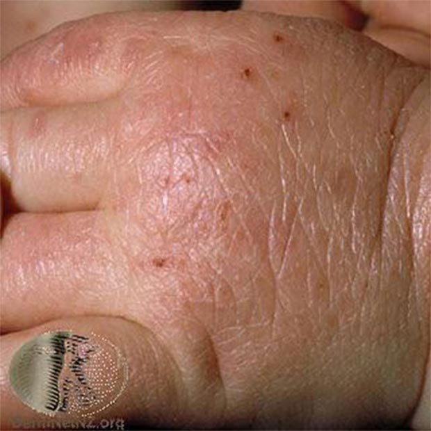 保濕觀念錯誤陷阱你也中了嗎?醫師圖文教你保濕關鍵_img_8