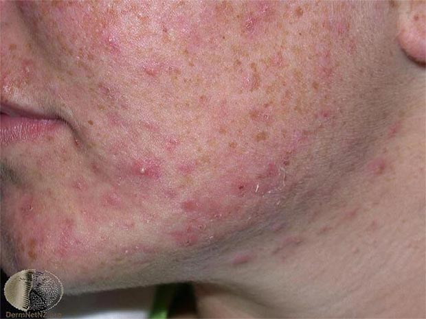 保濕觀念錯誤陷阱你也中了嗎?醫師圖文教你保濕關鍵_img_11