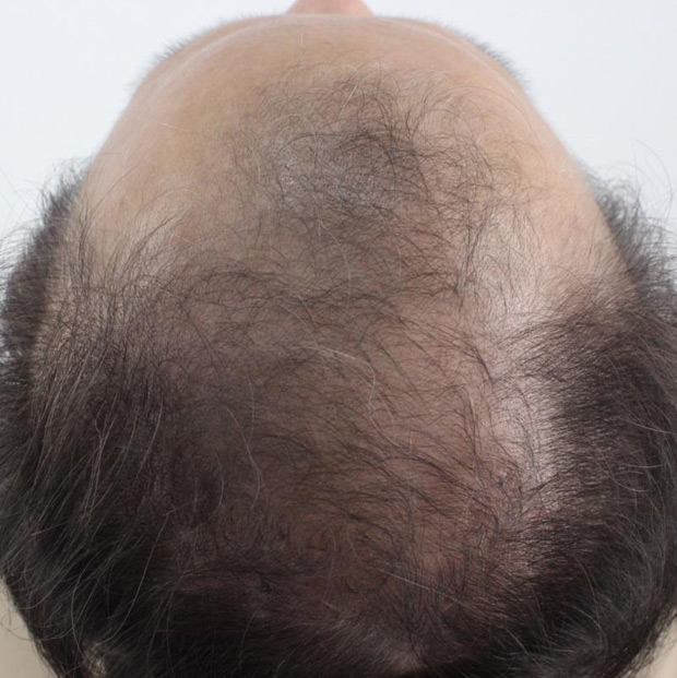 怎樣算是「異常掉髮」?醫師教你搞懂掉髮原因、及早辨識掉髮警訊_img_2