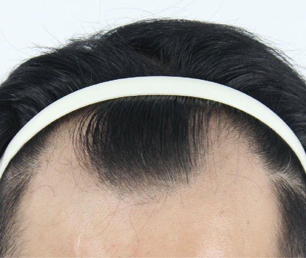 怎樣算是「異常掉髮」?醫師教你搞懂掉髮原因、及早辨識掉髮警訊_img_3