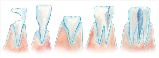 牙齒留,還是不留?把握黃金原則_img_1