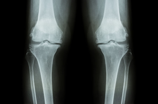 運動會不會造成膝蓋退化?_img_1