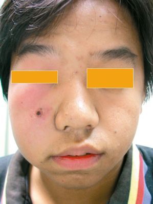 熱敷,讓粉瘤和粉刺自爆_img_1
